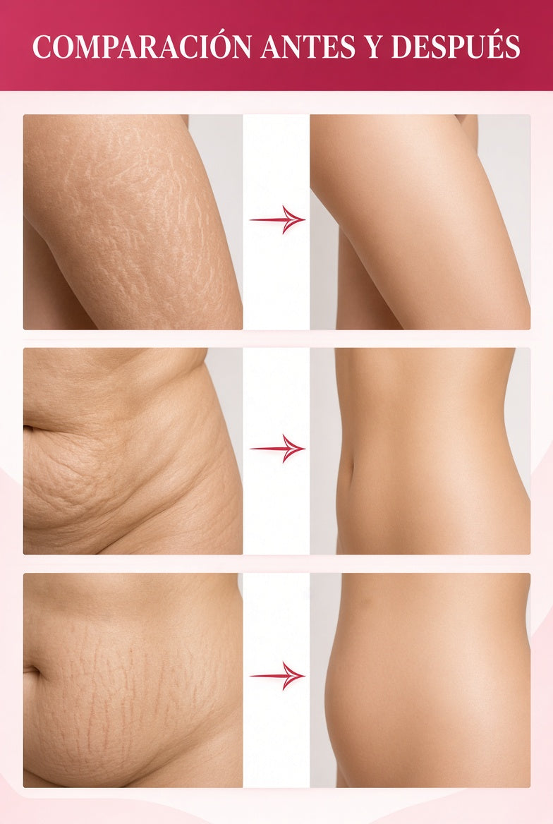 ADEUS Crema Corporal Intensiva para Estrías 300 g