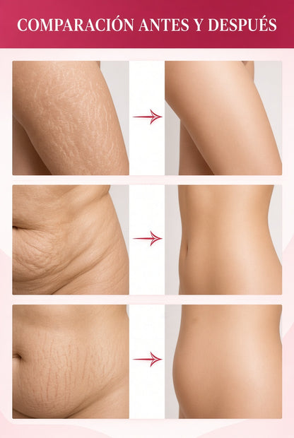 ADEUS Crema Corporal Intensiva para Estrías 300 g
